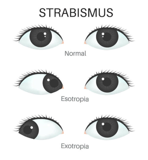 treatment of strabismus in Iran