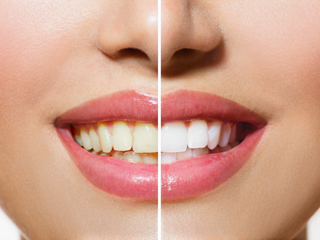 bigstock-Woman-Teeth-Before-and-after-W-55669106-sm